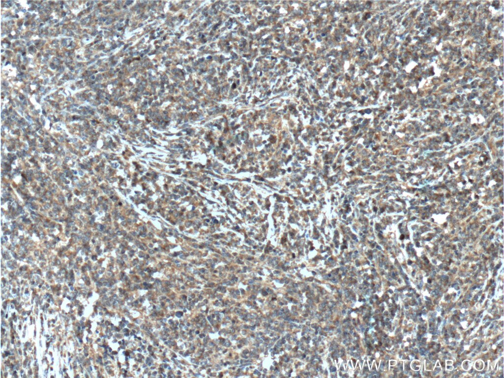 Immunohistochemistry (IHC) staining of human lymphoma tissue using CXCL13/BCA1 Polyclonal antibody (10927-1-AP)