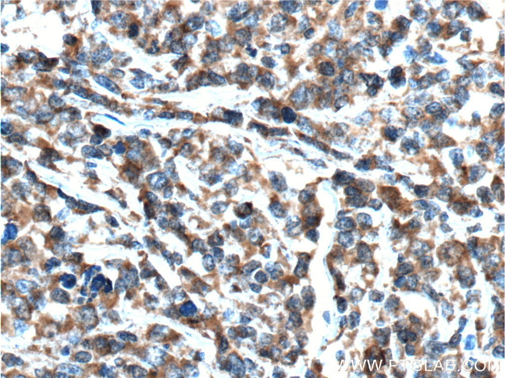 Immunohistochemistry (IHC) staining of human lymphoma tissue using CXCL13/BCA1 Polyclonal antibody (10927-1-AP)