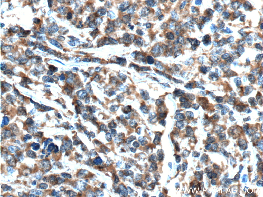 IHC staining of human lymphoma using 10927-1-AP