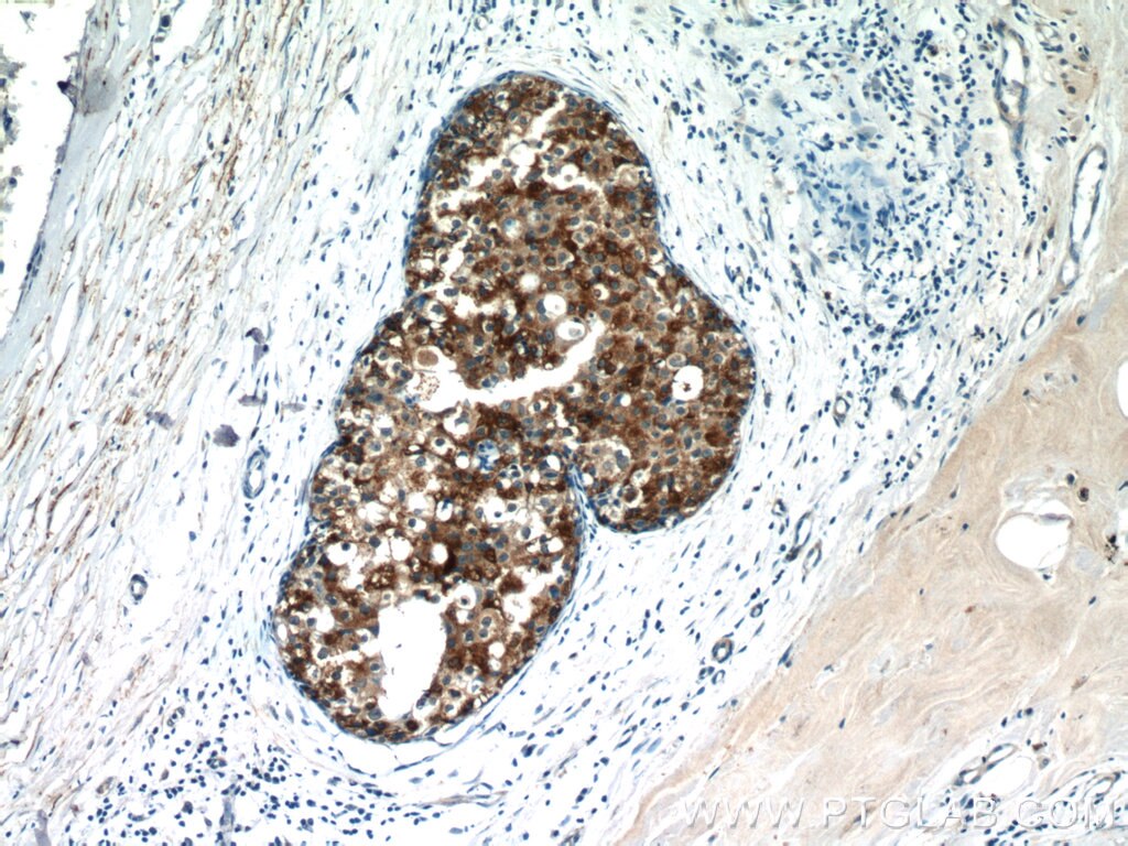 IHC staining of human breast cancer using 10927-1-AP