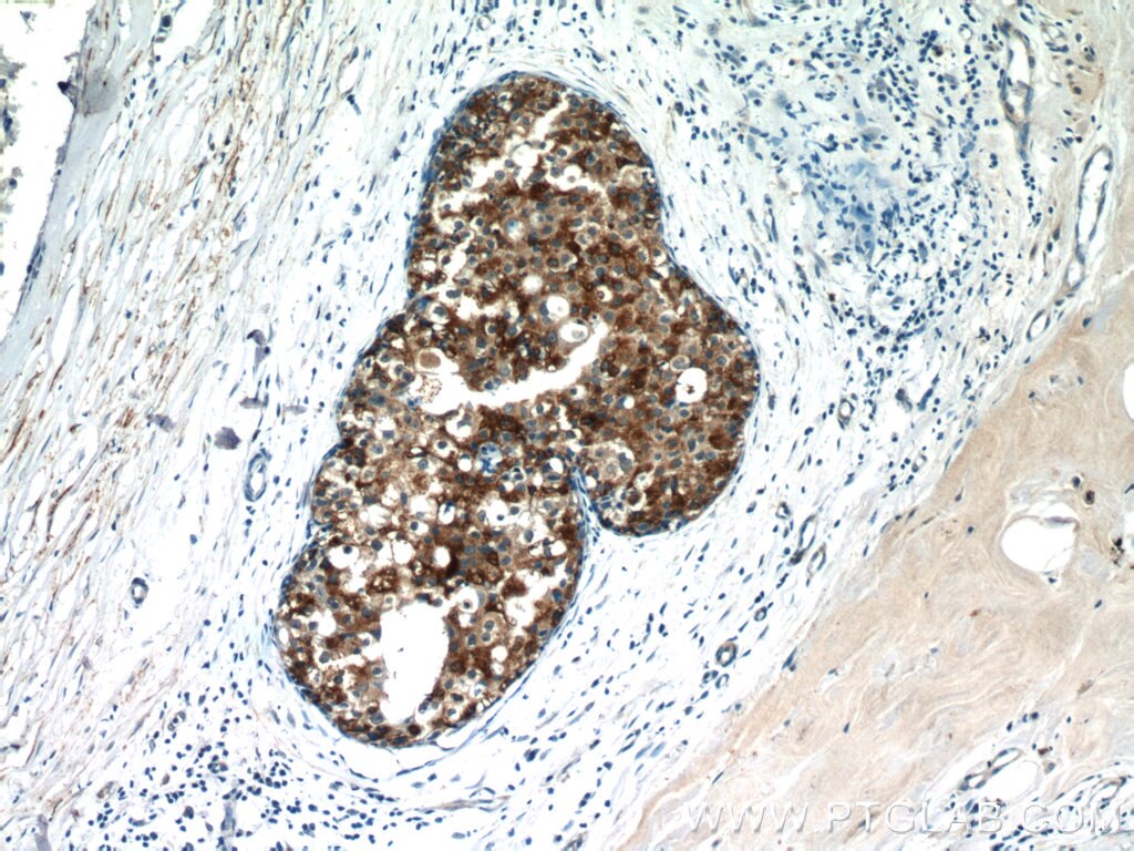 Immunohistochemistry (IHC) staining of human breast cancer tissue using CXCL13/BCA1 Polyclonal antibody (10927-1-AP)