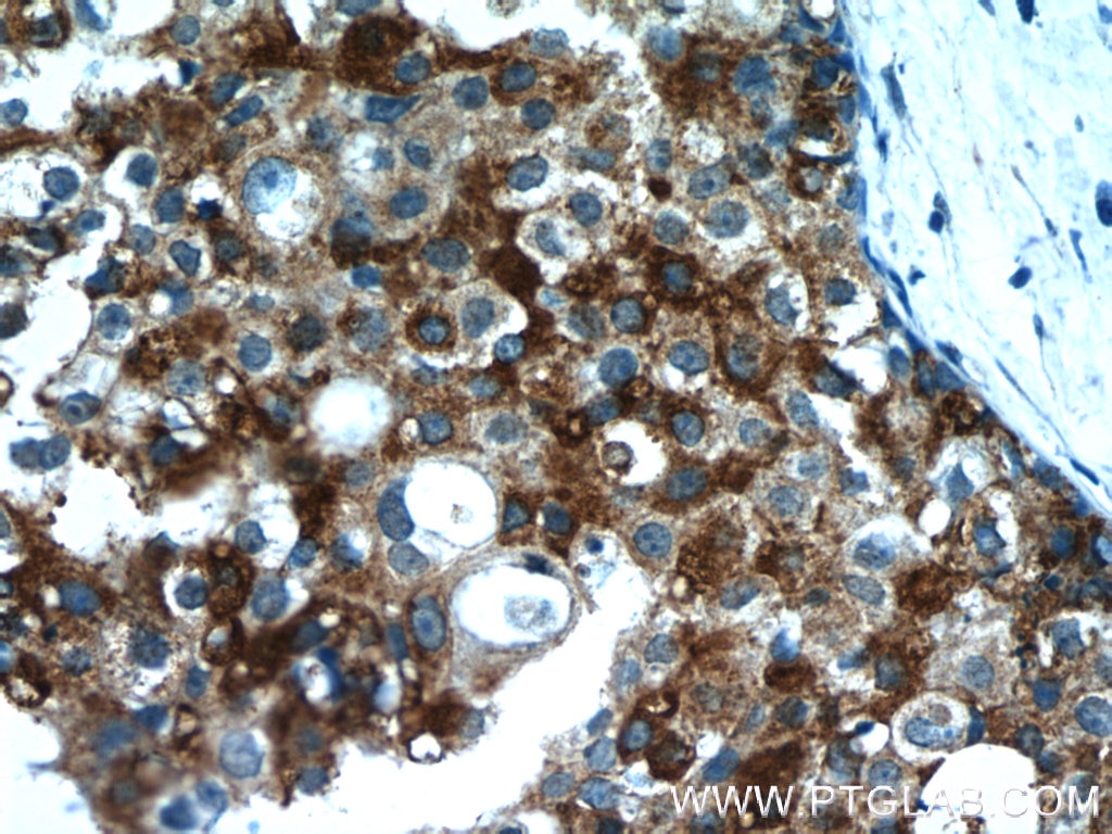 Immunohistochemistry (IHC) staining of human breast cancer tissue using CXCL13/BCA1 Polyclonal antibody (10927-1-AP)