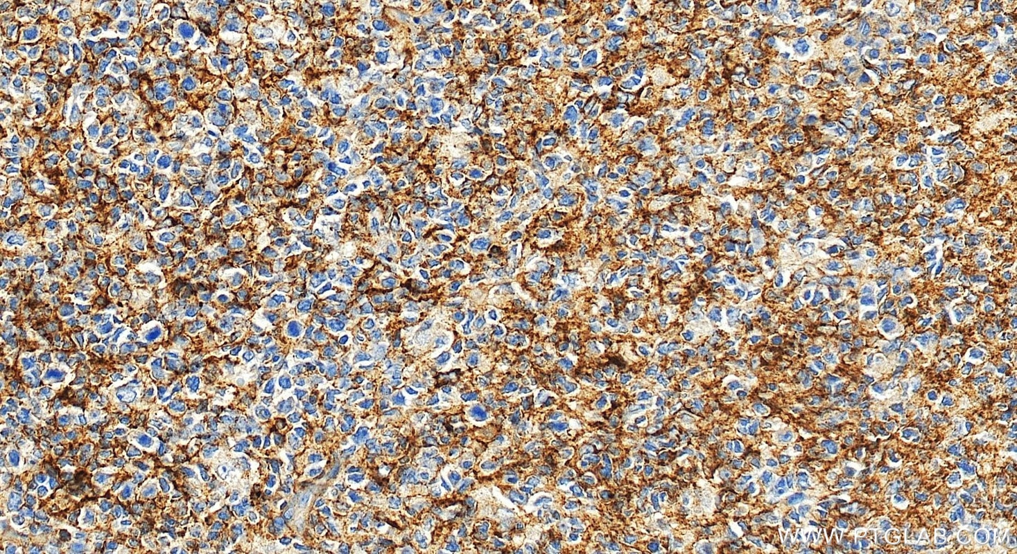 IHC staining of human tonsillitis using 10927-1-AP Immunohistochemistry (IHC) staining of human tonsillitis tissue using CXCL13/BCA1 Polyclonal antibody (10927-1-AP)