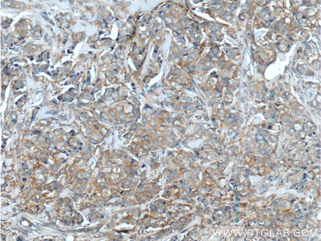 Immunohistochemistry (IHC) staining of human breast cancer tissue using CXCL14 Polyclonal antibody (10468-1-AP)