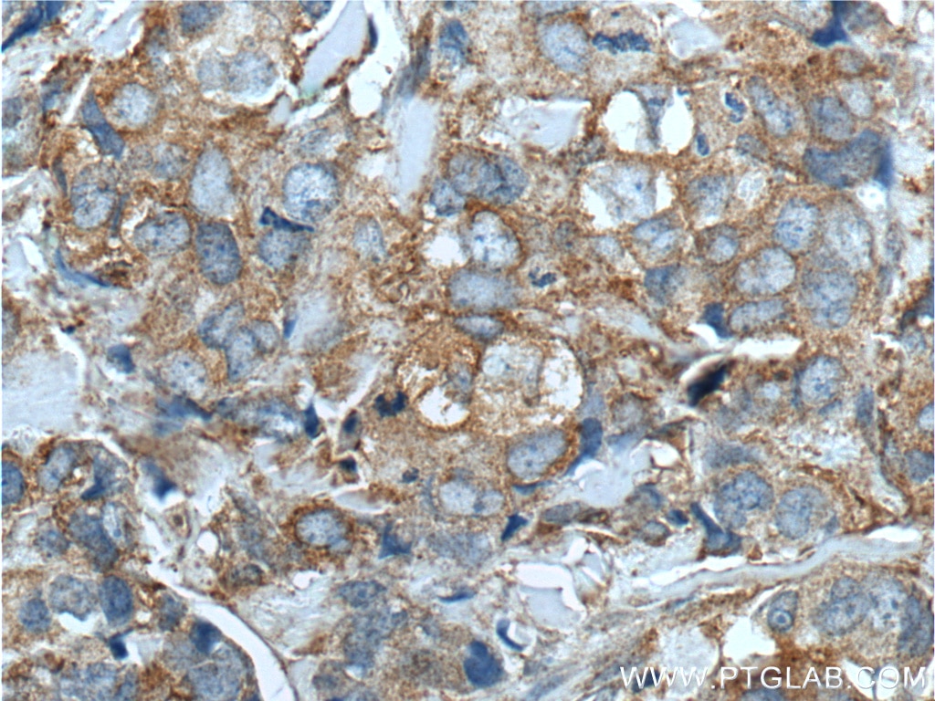 IHC staining of human breast cancer using 10468-1-AP