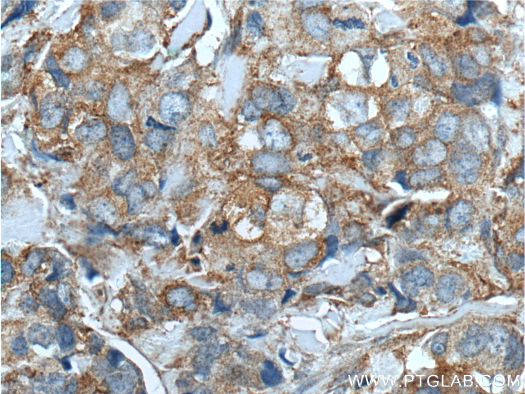 Immunohistochemistry (IHC) staining of human breast cancer tissue using CXCL14 Polyclonal antibody (10468-1-AP)