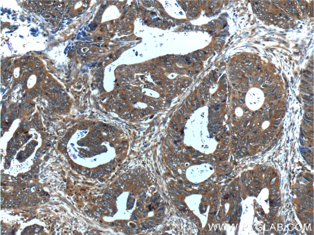 Immunohistochemistry (IHC) staining of human colon cancer tissue using CXCL14 Polyclonal antibody (10468-1-AP)