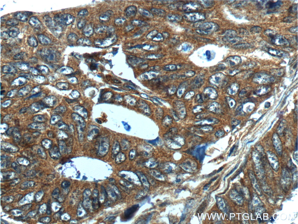 IHC staining of human colon cancer using 10468-1-AP