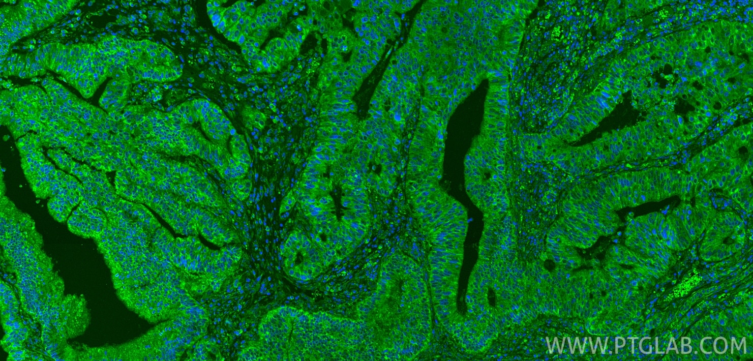 Immunofluorescence (IF) / fluorescent staining of human colon cancer tissue using CXCL17 Polyclonal antibody (18108-1-AP)