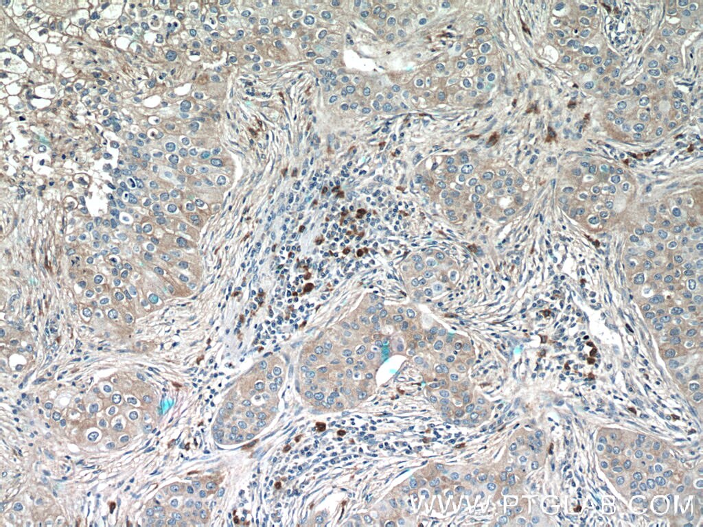 Immunohistochemistry (IHC) staining of human breast cancer tissue using CXCL17 Polyclonal antibody (18108-1-AP)