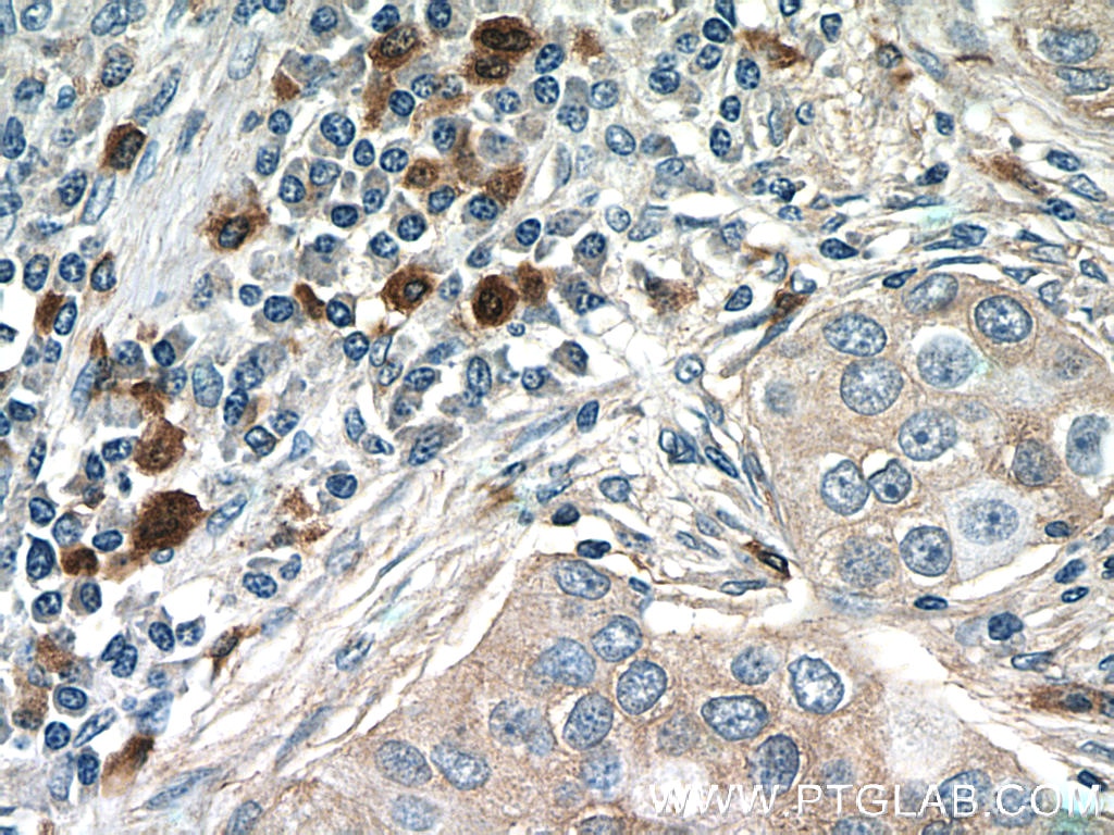 Immunohistochemistry (IHC) staining of human breast cancer tissue using CXCL17 Polyclonal antibody (18108-1-AP)