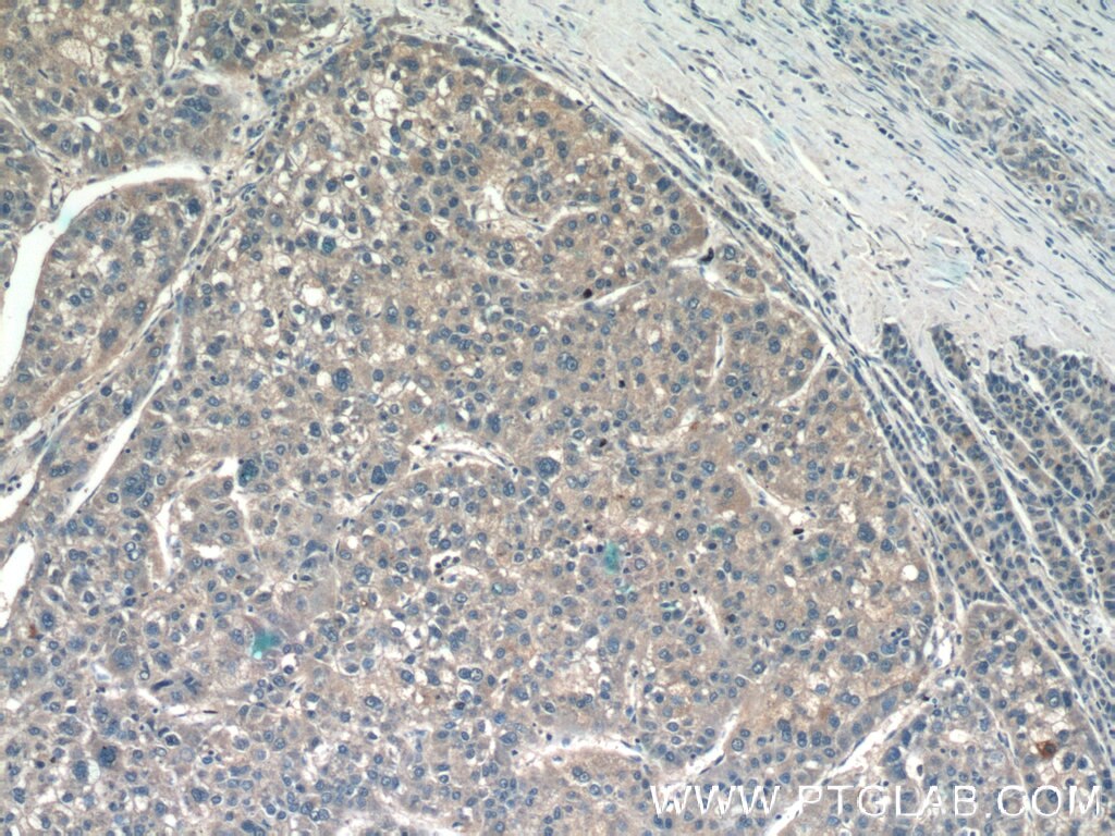 Immunohistochemistry (IHC) staining of human liver cancer tissue using CXCL17 Polyclonal antibody (18108-1-AP)