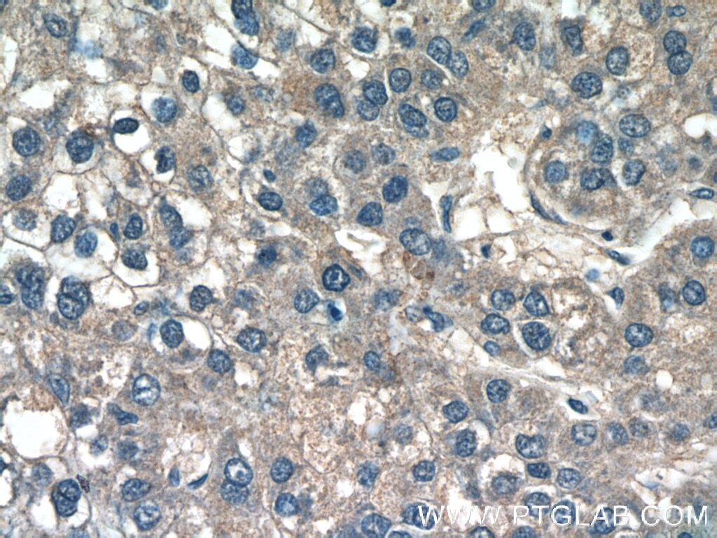 Immunohistochemistry (IHC) staining of human liver cancer tissue using CXCL17 Polyclonal antibody (18108-1-AP)