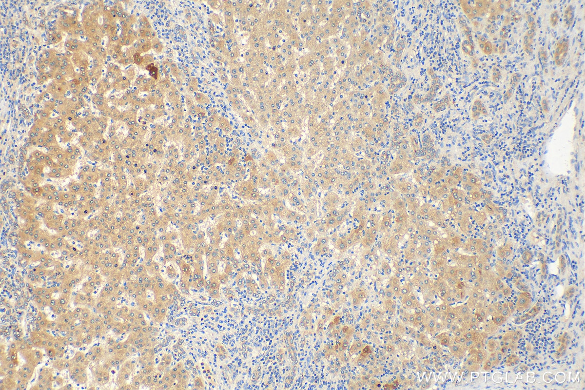 Immunohistochemistry (IHC) staining of human liver cancer tissue using CXCL17 Polyclonal antibody (18108-1-AP)