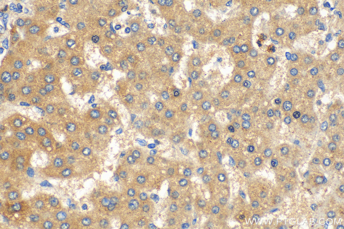 Immunohistochemistry (IHC) staining of human liver cancer tissue using CXCL17 Polyclonal antibody (18108-1-AP)