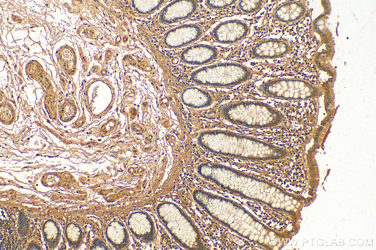 Immunohistochemistry (IHC) staining of human colon cancer tissue using CXCL17 Polyclonal antibody (18108-1-AP)