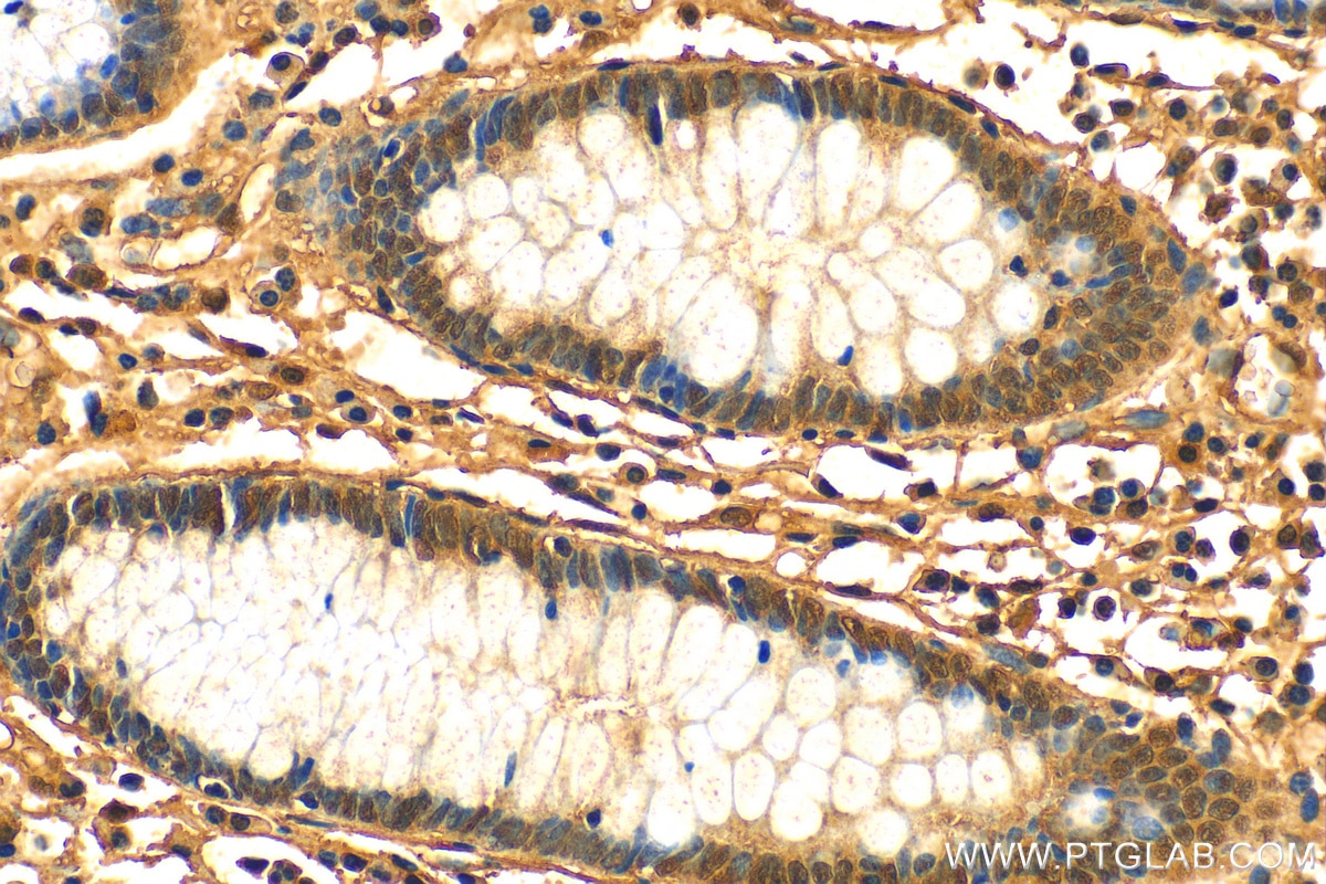 IHC staining of human colon cancer using 18108-1-AP
