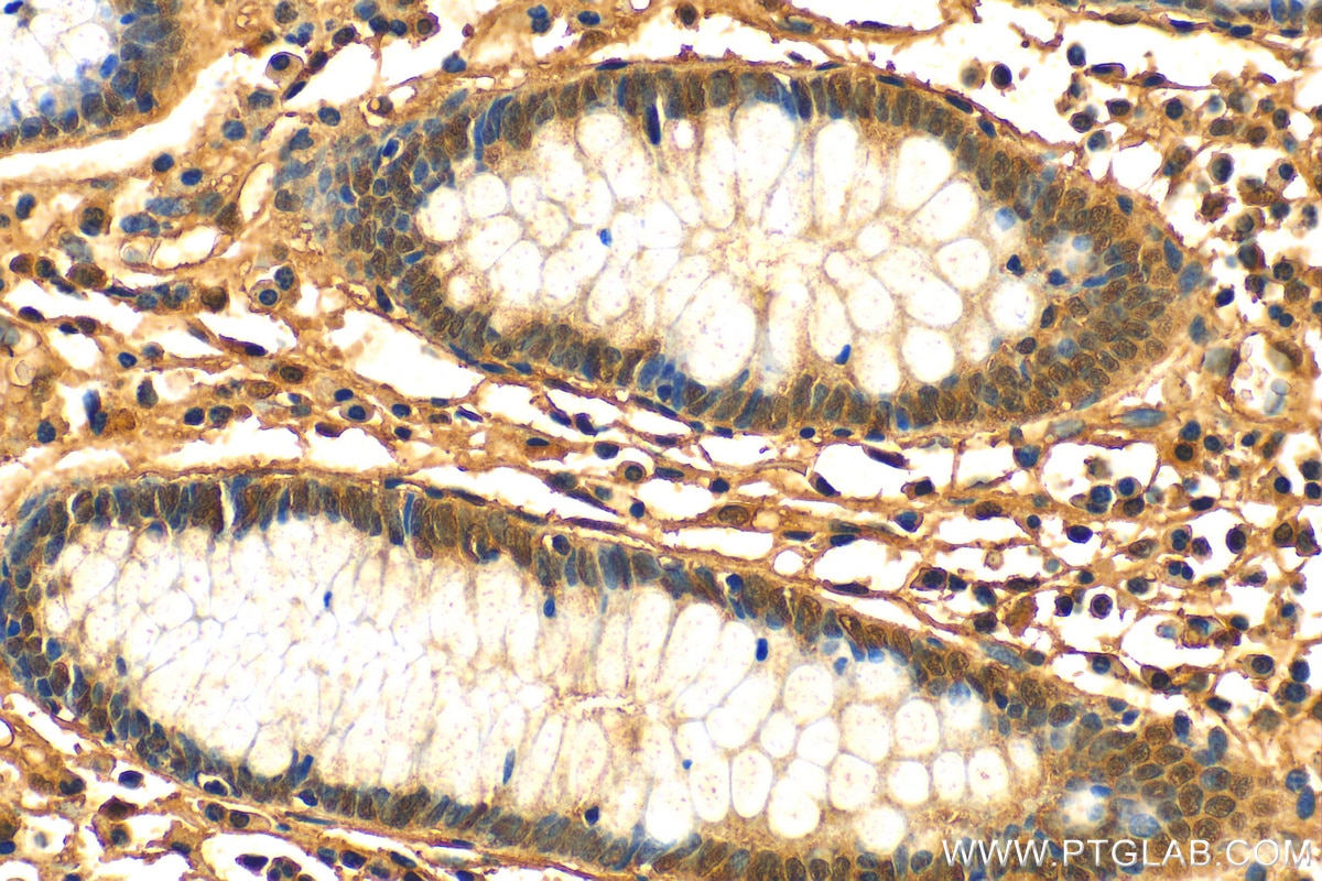Immunohistochemistry (IHC) staining of human colon cancer tissue using CXCL17 Polyclonal antibody (18108-1-AP)