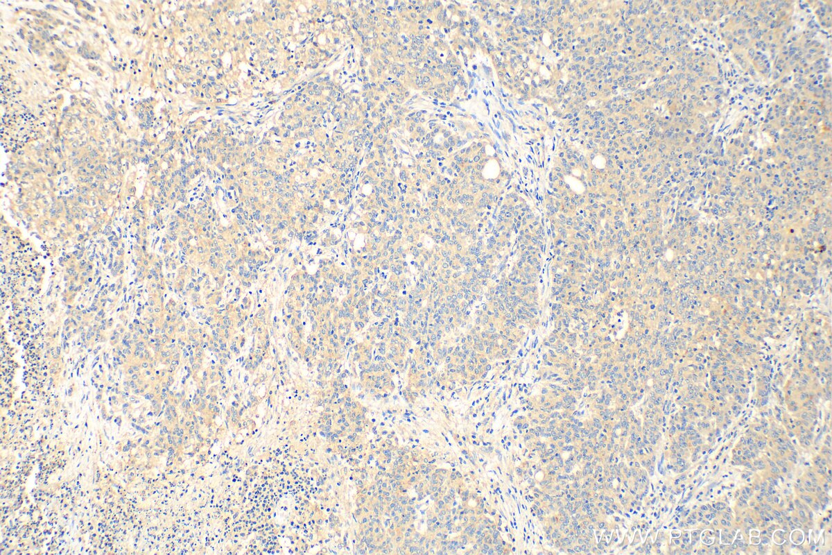 Immunohistochemistry (IHC) staining of human stomach cancer tissue using CXCL17 Polyclonal antibody (18108-1-AP)