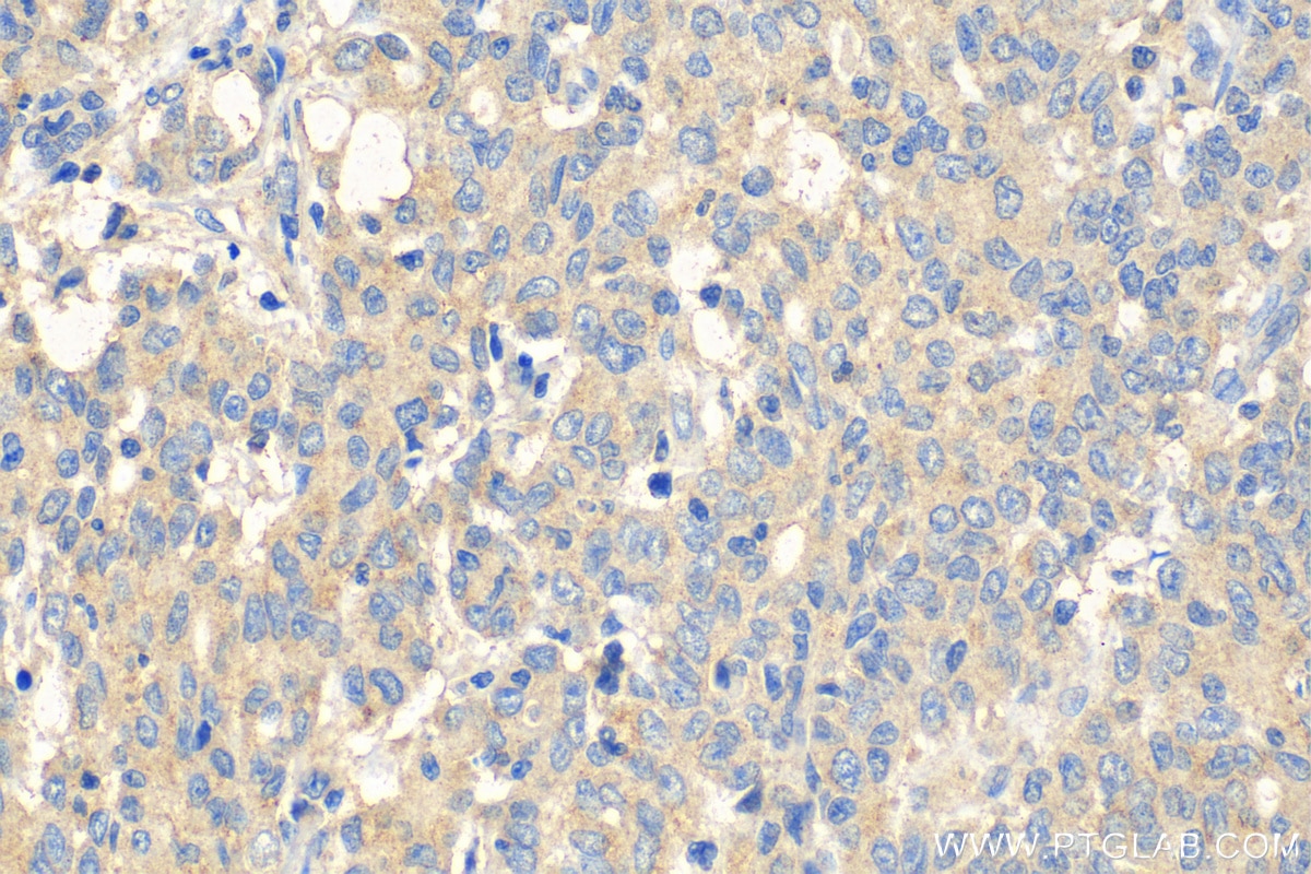 Immunohistochemistry (IHC) staining of human stomach cancer tissue using CXCL17 Polyclonal antibody (18108-1-AP)