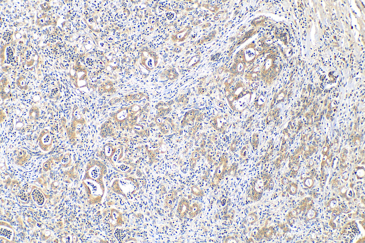 Immunohistochemistry (IHC) staining of human stomach cancer tissue using CXCL17 Polyclonal antibody (18108-1-AP)