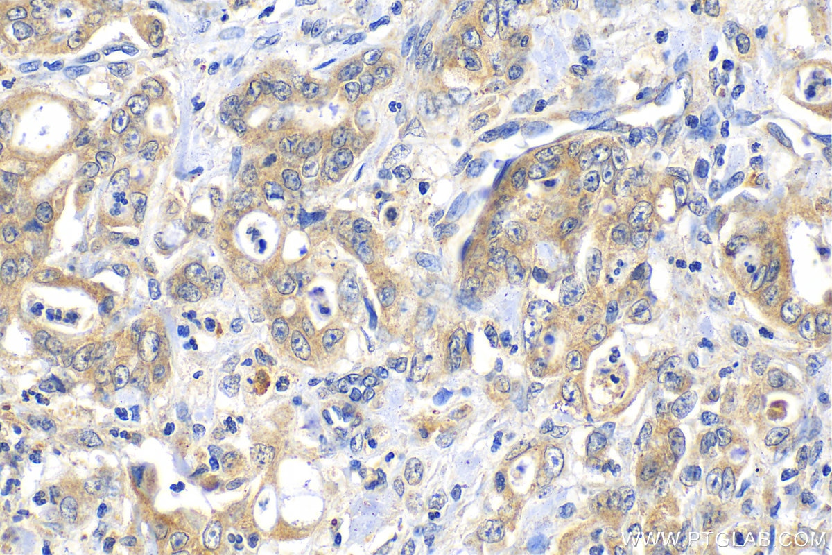 Immunohistochemistry (IHC) staining of human stomach cancer tissue using CXCL17 Polyclonal antibody (18108-1-AP)