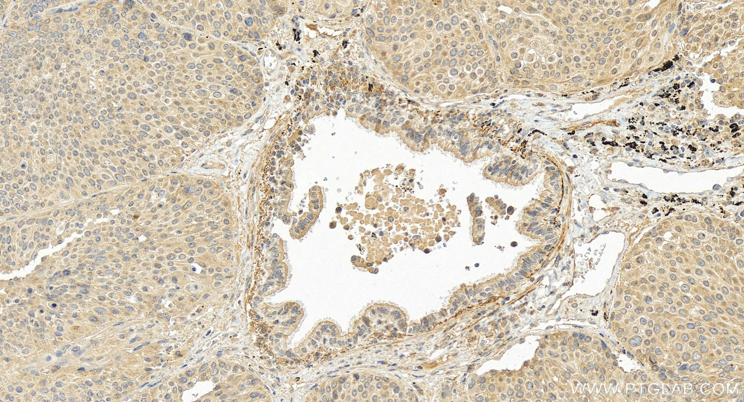Immunohistochemical analysis of paraffin-embedded human lung squamous cell carcinoma tissue slide using 18108-1-AP (CXCL17 antibody) at dilution of 1:200 (under 20x lens). Heat mediated antigen retrieval with Tris-EDTA buffer (pH 9.0). Immunohistochemistry (IHC) staining of human lung squamous cell carcinoma tissue using CXCL17 Polyclonal antibody (18108-1-AP)