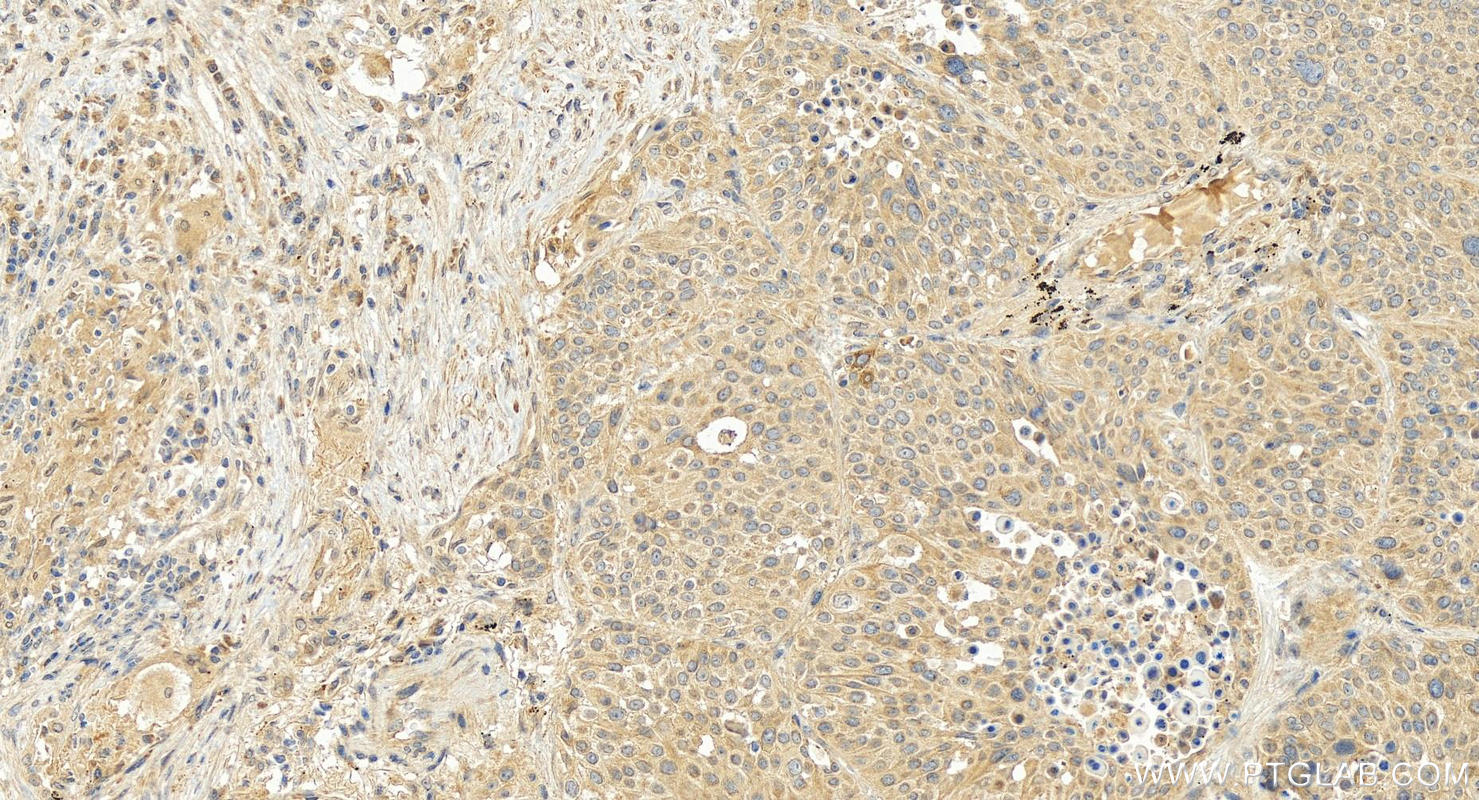 Immunohistochemical analysis of paraffin-embedded human lung squamous cell carcinoma tissue slide using 18108-1-AP (CXCL17 antibody) at dilution of 1:200 (under 20x lens). Heat mediated antigen retrieval with Tris-EDTA buffer (pH 9.0). Immunohistochemistry (IHC) staining of human lung squamous cell carcinoma tissue using CXCL17 Polyclonal antibody (18108-1-AP)