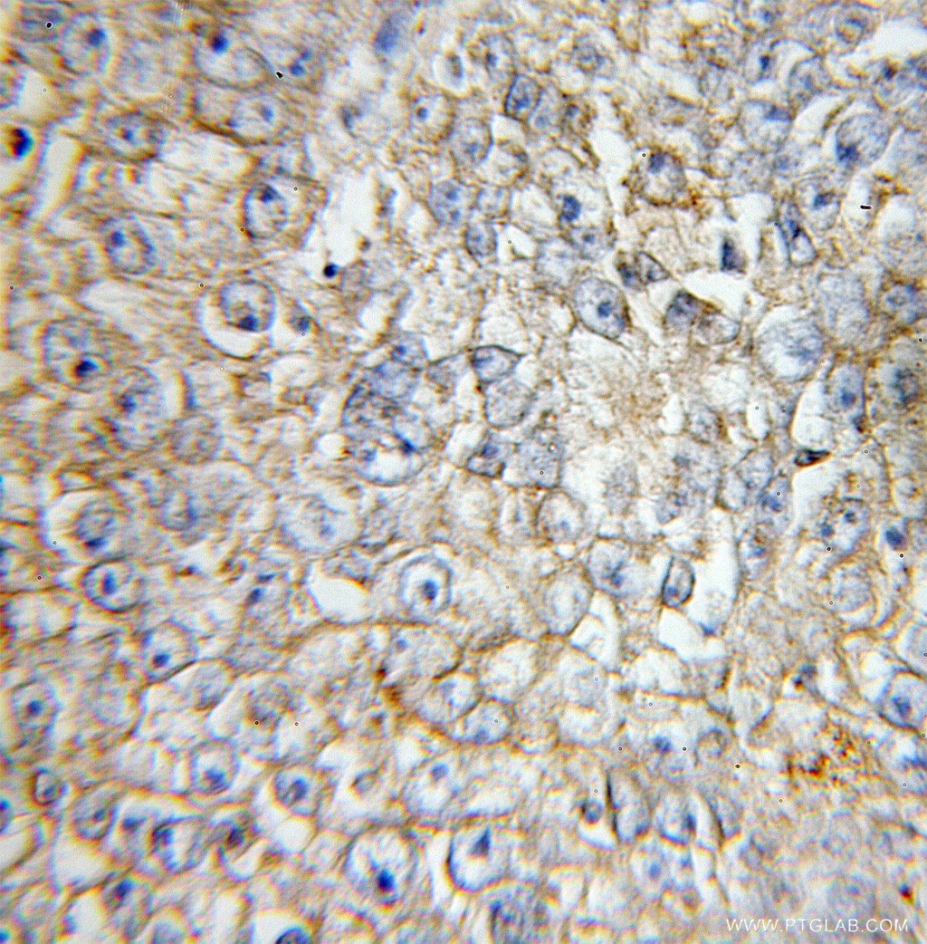 Immunohistochemistry (IHC) staining of human lung cancer tissue using CXCL/GRO Gamma Polyclonal antibody (11221-1-AP)