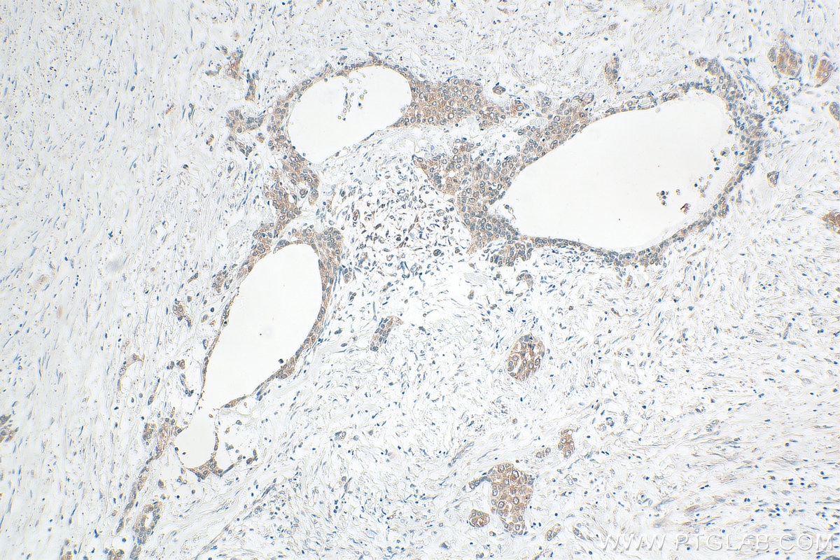 Immunohistochemical analysis of paraffin-embedded human urothelial carcinoma tissue slide using 10809-1-AP (LIX/CXCL5 antibody) at dilution of 1:400 (under 10x lens). Heat mediated antigen retrieval with Tris-EDTA buffer (pH 9.0). Immunohistochemistry (IHC) staining of human urothelial carcinoma tissue using LIX/CXCL5 Polyclonal antibody (10809-1-AP)