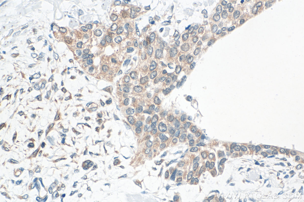 Immunohistochemical analysis of paraffin-embedded human urothelial carcinoma tissue slide using 10809-1-AP (LIX/CXCL5 antibody) at dilution of 1:400 (under 40x lens). Heat mediated antigen retrieval with Tris-EDTA buffer (pH 9.0). Immunohistochemistry (IHC) staining of human urothelial carcinoma tissue using LIX/CXCL5 Polyclonal antibody (10809-1-AP)