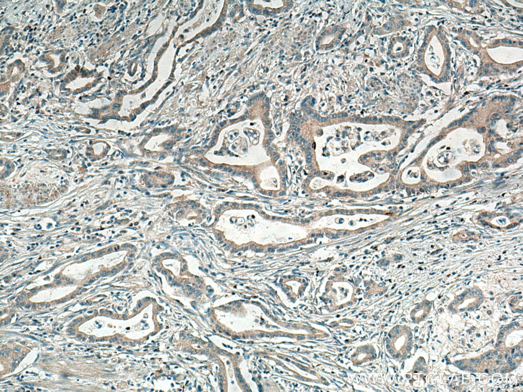 Immunohistochemistry (IHC) staining of human pancreas cancer tissue using CXCL8/IL-8 Polyclonal antibody (17038-1-AP)