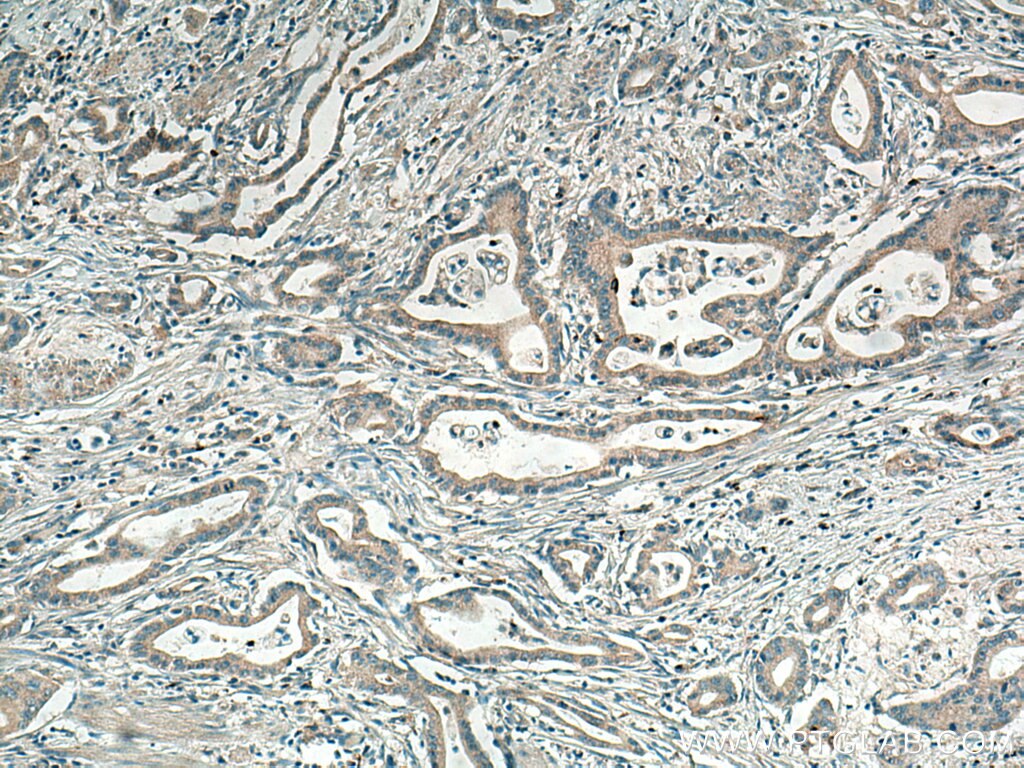 IHC staining of human pancreas cancer using 17038-1-AP