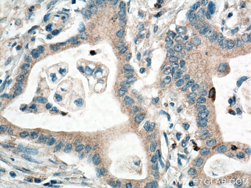 Immunohistochemistry (IHC) staining of human pancreas cancer tissue using CXCL8/IL-8 Polyclonal antibody (17038-1-AP)