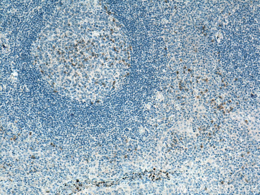 Immunohistochemistry (IHC) staining of human tonsillitis tissue using CXCL8/IL-8 Polyclonal antibody (17038-1-AP)