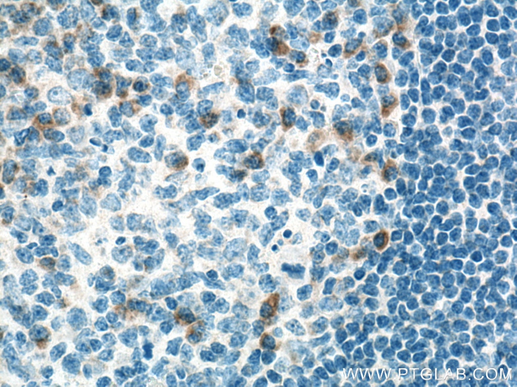 Immunohistochemistry (IHC) staining of human tonsillitis tissue using CXCL8/IL-8 Polyclonal antibody (17038-1-AP)