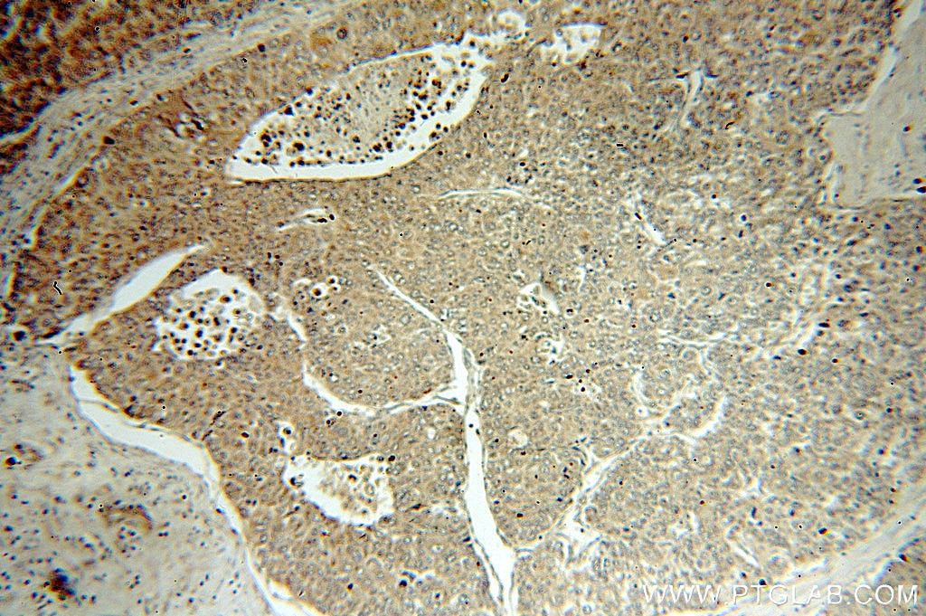 Immunohistochemistry (IHC) staining of human liver cancer tissue using CXCL8/IL-8 Monoclonal antibody (60141-1-Ig)