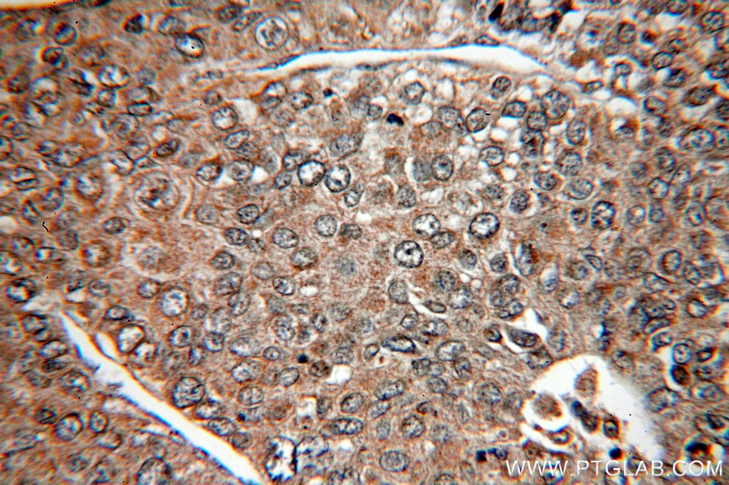 Immunohistochemistry (IHC) staining of human liver cancer tissue using CXCL8/IL-8 Monoclonal antibody (60141-1-Ig)