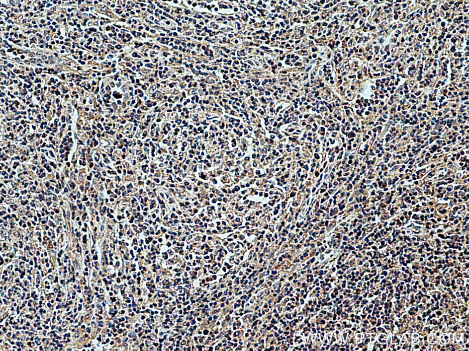 Immunohistochemistry (IHC) staining of human lymphoma tissue using CXCL8/IL-8 Polyclonal antibody (27095-1-AP)