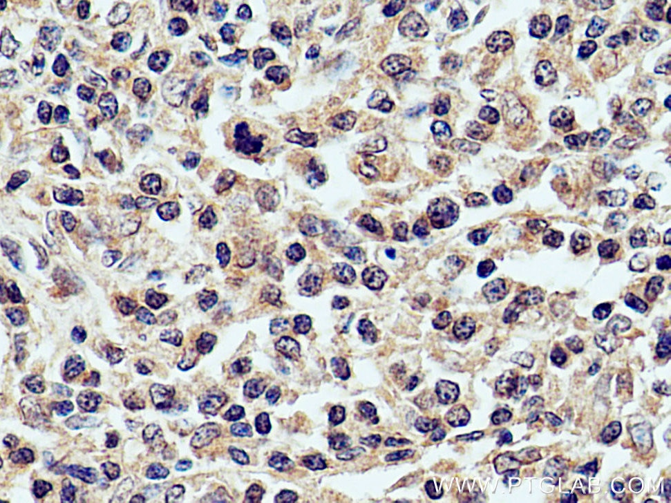 Immunohistochemistry (IHC) staining of human lymphoma tissue using CXCL8/IL-8 Polyclonal antibody (27095-1-AP)