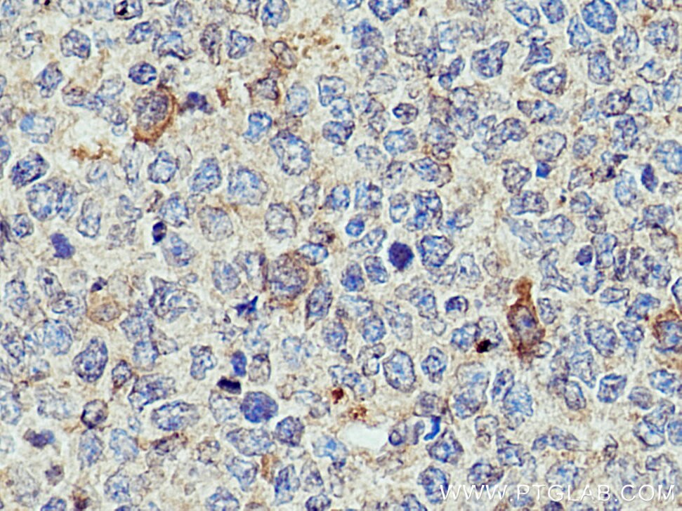 Immunohistochemistry (IHC) staining of human tonsillitis tissue using CXCL8/IL-8 Polyclonal antibody (27095-1-AP)