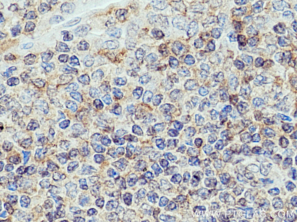 Immunohistochemistry (IHC) staining of human tonsillitis tissue using CXCL8/IL-8 Polyclonal antibody (27095-1-AP)