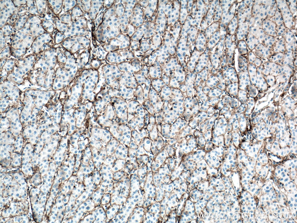 Immunohistochemistry (IHC) staining of human liver cancer tissue using CXCR3B-specific Monoclonal antibody (60065-1-Ig)