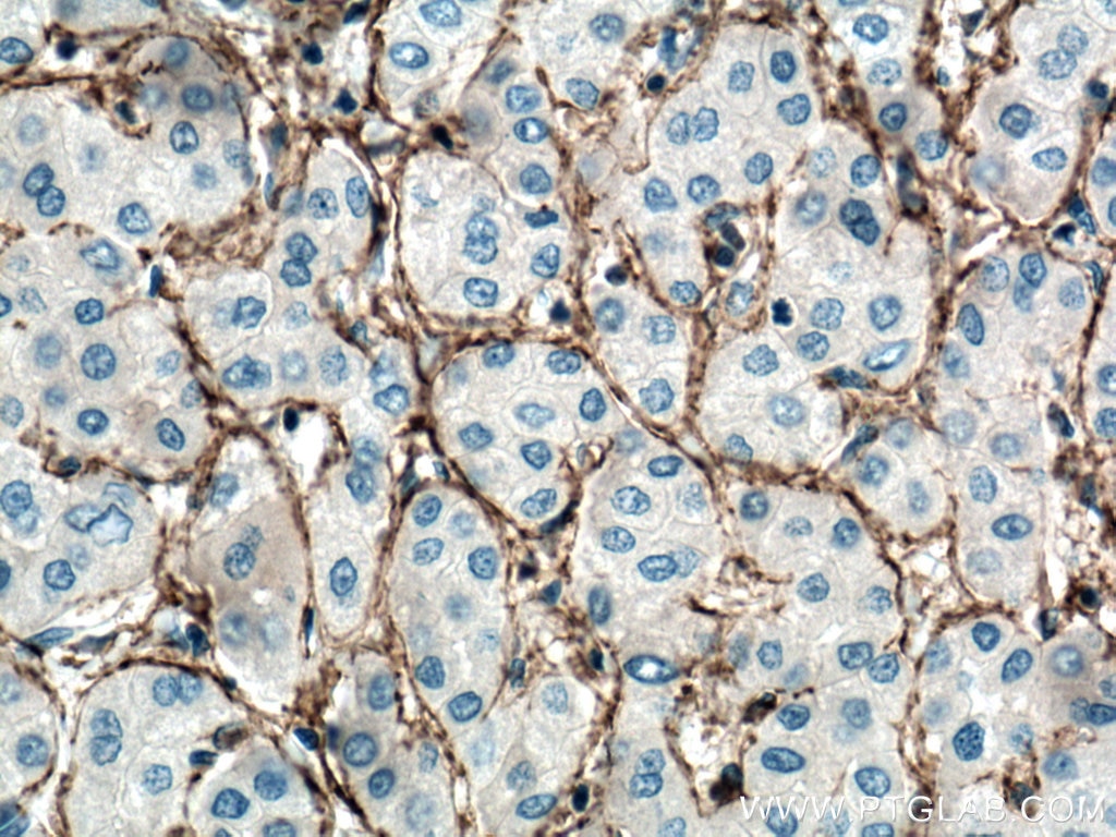 Immunohistochemistry (IHC) staining of human liver cancer tissue using CXCR3B-specific Monoclonal antibody (60065-1-Ig)