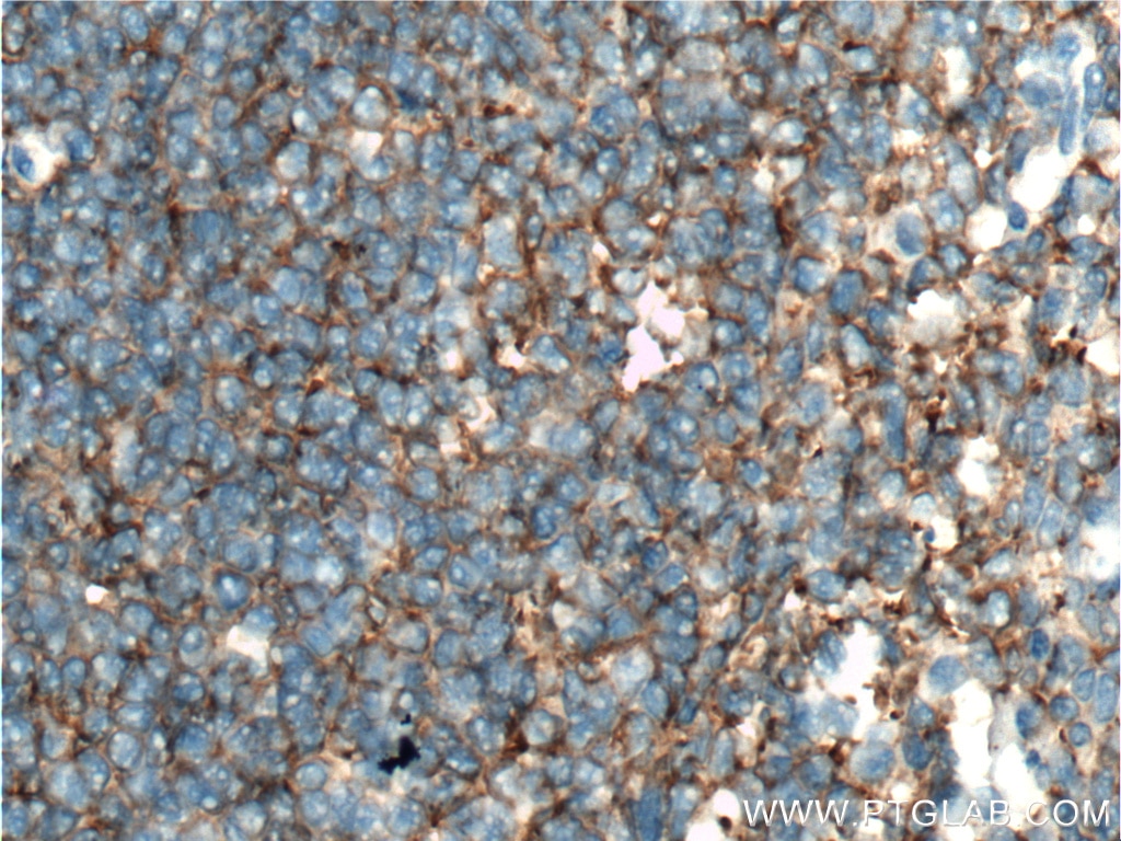 Immunohistochemistry (IHC) staining of human tonsillitis tissue using CXCR3B-specific Monoclonal antibody (60065-1-Ig)