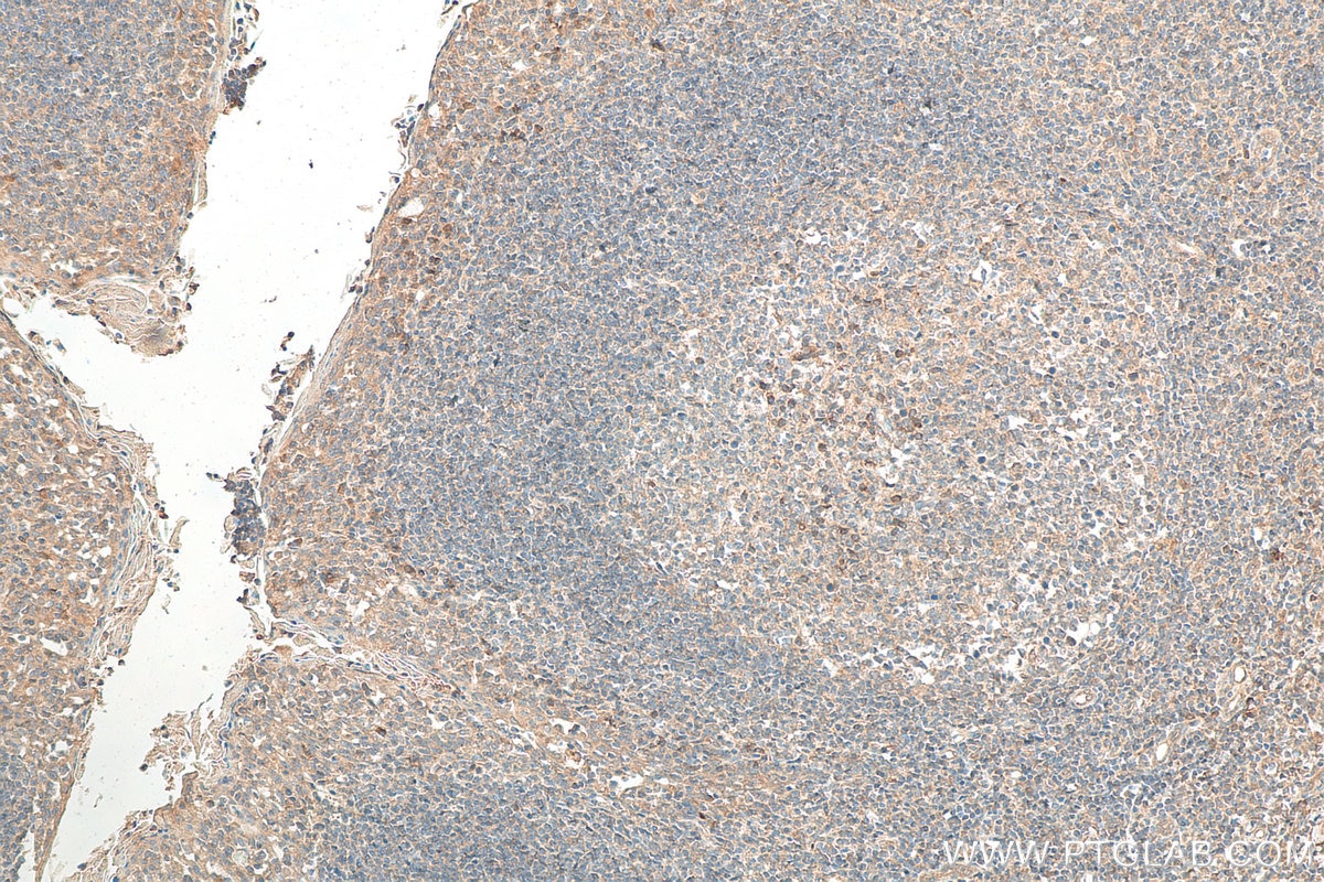 Immunohistochemistry (IHC) staining of human tonsillitis tissue using CXCR4 Polyclonal antibody (11073-2-AP)