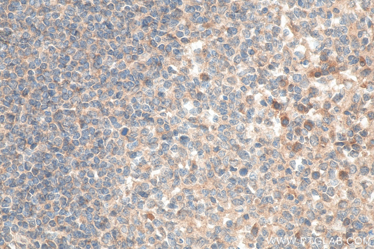 Immunohistochemistry (IHC) staining of human tonsillitis tissue using CXCR4 Polyclonal antibody (11073-2-AP)