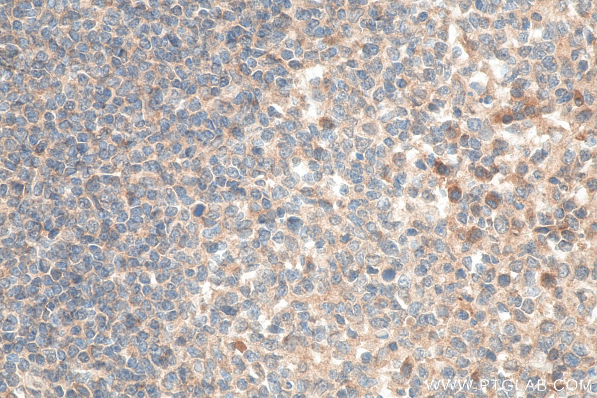 IHC staining of human tonsillitis using 11073-2-AP