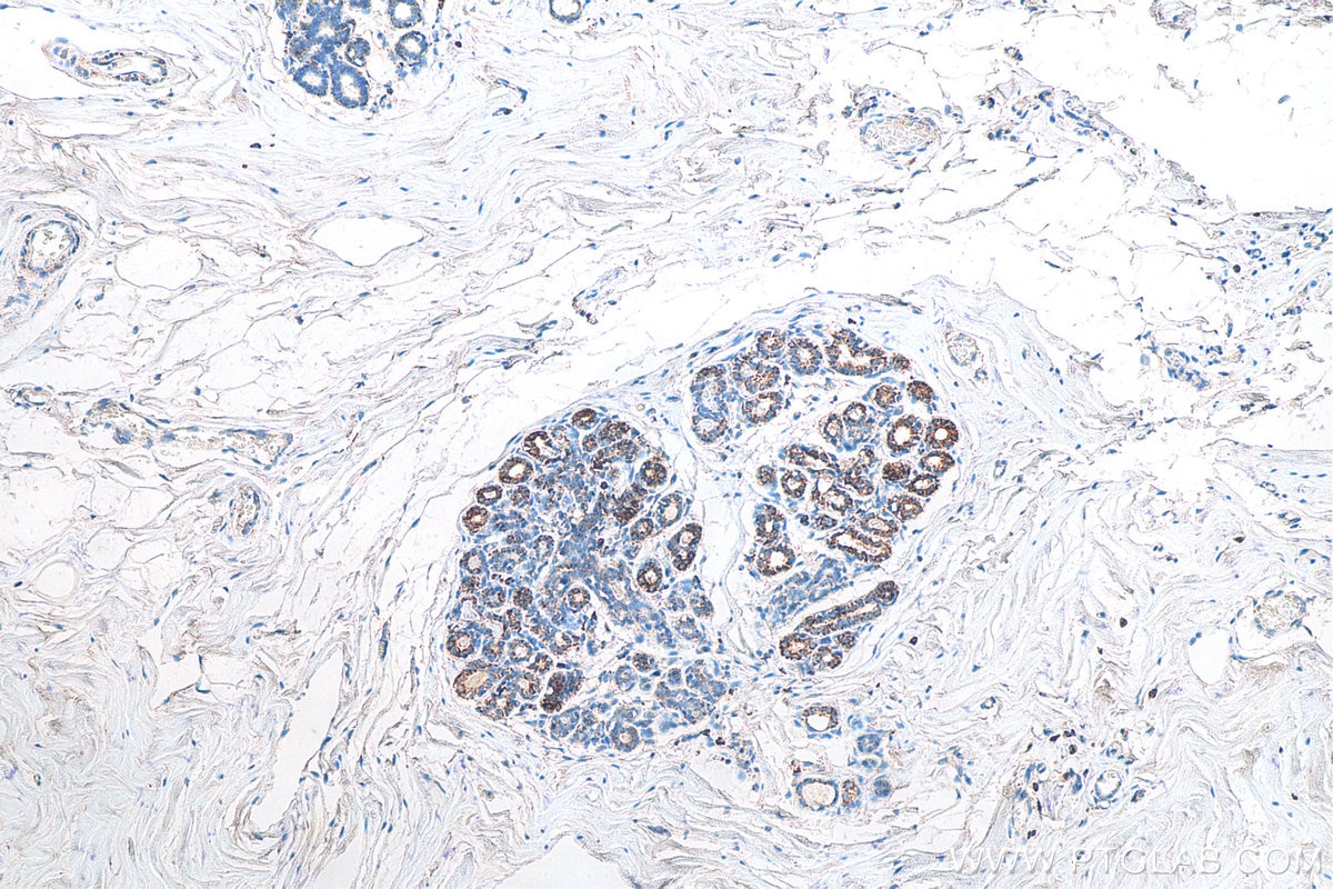 IHC staining of human breast cancer using 60042-1-Ig