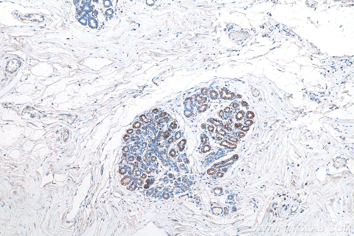 Immunohistochemistry (IHC) staining of human breast cancer tissue using CXCR4 Monoclonal antibody (60042-1-Ig)